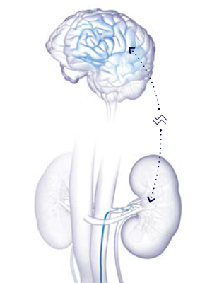 imagem - Como funciona a denervação renal com o Symplicity Spyral™
